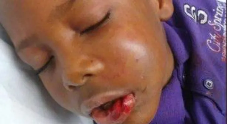 Acusan a tutor de abuso infantil contra un niño con fractura de mandíbula