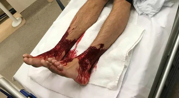 ¿Podrían ser las pulgas marinas responsables de estas picaduras?