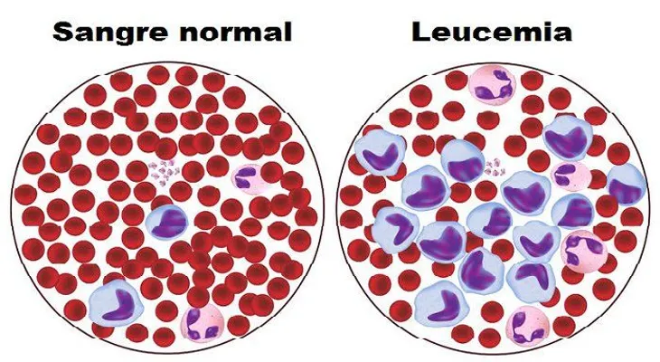 6 signos de leucemia que toda mujer debe saber