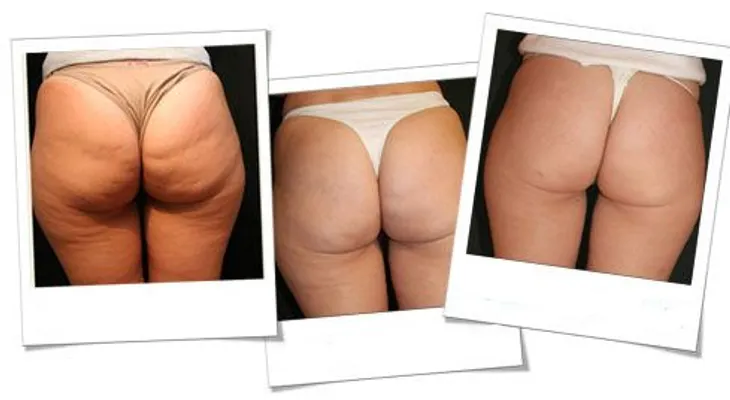 Cómo evitar la celulitis en las piernas