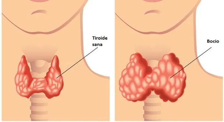 5 hábitos que alteran tu tiroides