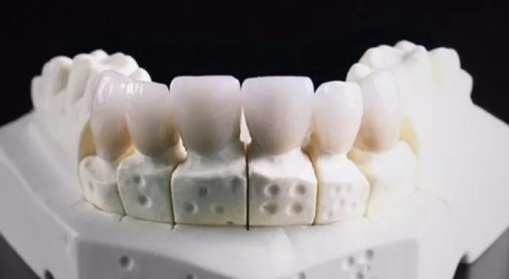 Crean dientes con impresión 3D que serán antibacterianos