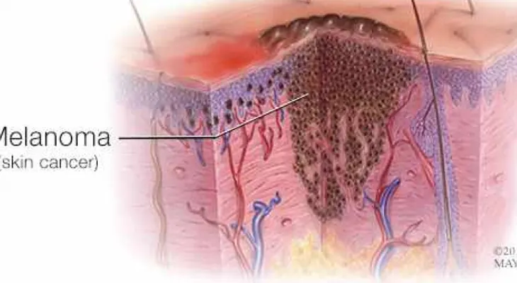 ¿Tiene estos factores de riesgo para melanoma?