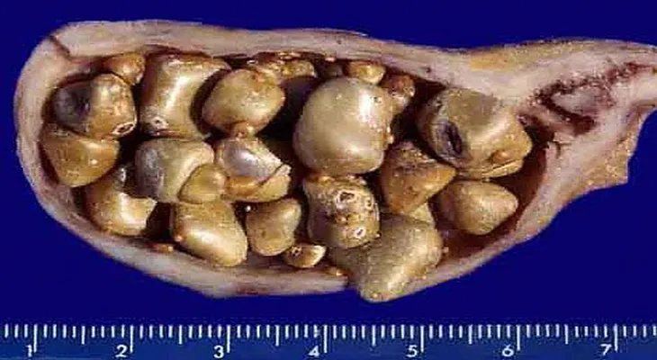 Misterio chino revelado. Esto termina con todas las piedras de la vesícula en sólo 1 semana