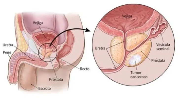 Estas 5 señales podrían advertir cáncer de próstata