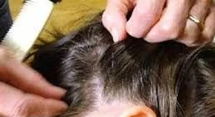 Sácale los piojos de manera efectiva y natural con estos tres remedios 