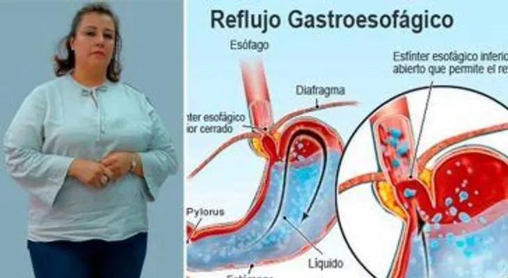 Sufría de reflujo causado por la obesidad y los medicamentos, pero con esto pude eliminarlo