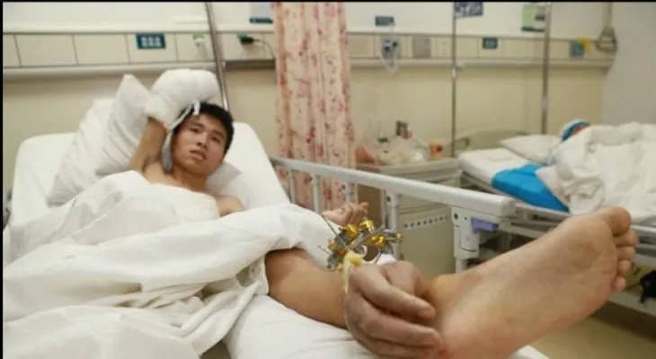 Tuvieron que implantarle la mano en la pierna para seguir con vida 