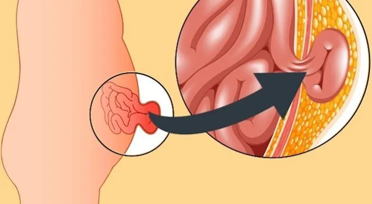 Diferencias entre hernia y desgarro abdominal