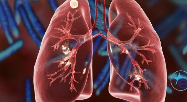 Estudio da visto bueno a nueva vacuna contra la tuberculosis