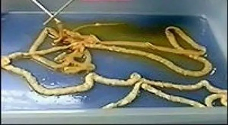Te asombrará cuando descubra lo que vivía en el estómago de este hombre