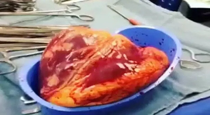 Impactante video: El corazón extirpado a un paciente late 25 minutos... ¡fuera del cuerpo!