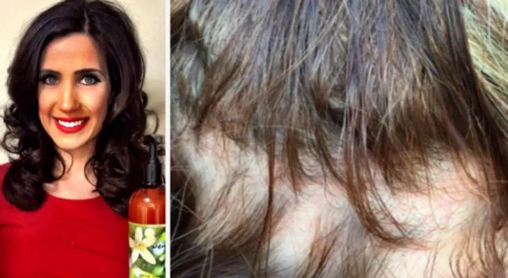 Una mujer se quedó CALVA luego de usar este famoso SHAMPOO!