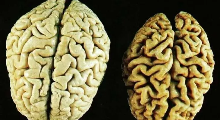 Cómo prevenir el deterioro del cerebro con estas 3 vitaminas beneficiosas