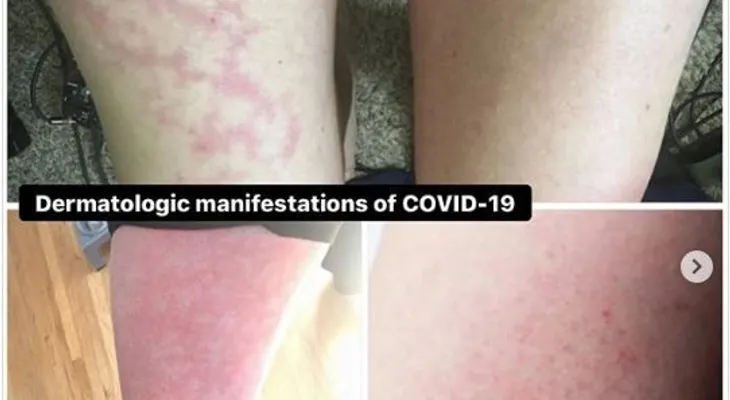 El coronavirus puede aparecer con erupciones en la piel, sobre todo en niños y jóvenes, según descubrimiento 