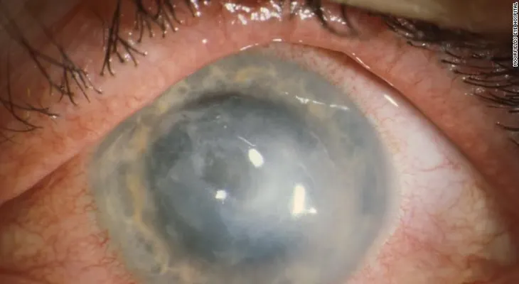 Alerta por aumento casos de una rara infección en los ojos por usar lentes de contacto