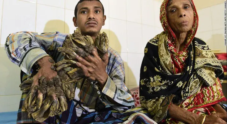 El 'hombre-árbol' de Bangladesh irá a cirugía para que le quiten sus 'ramas'