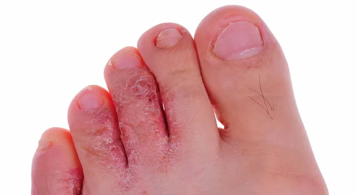 Vinagre de manzana para disminuir los hongos en la uñas y los callos de los pies