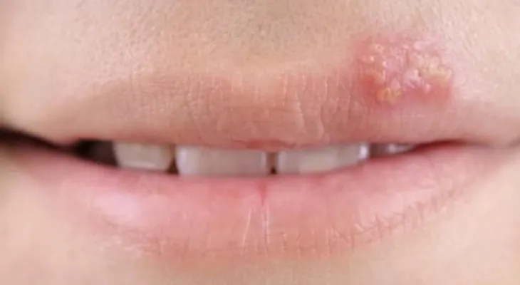 Si tienes menos de 50 años, es probable que tengas herpes
