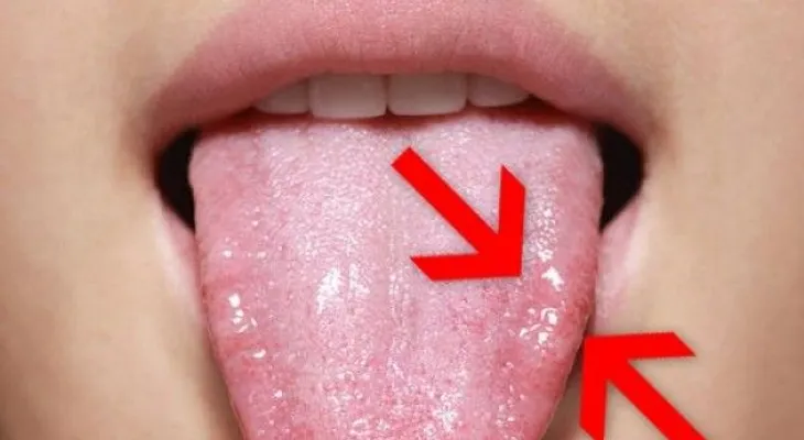9 remedios naturales para tratar la candidiasis