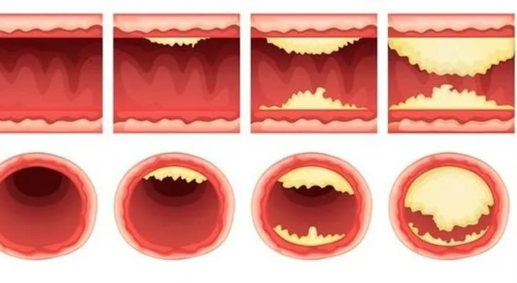3 ingredientes que destapan las arterias y protegen al corazón naturalmente!