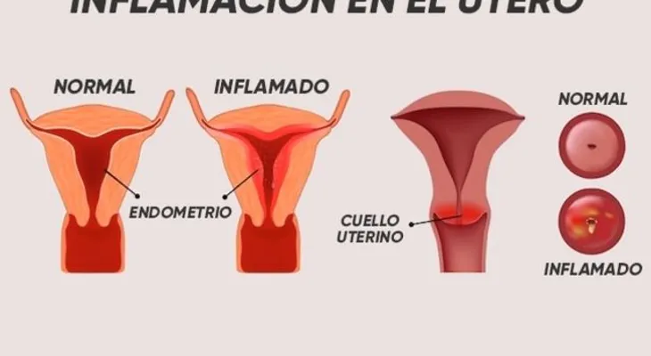  Remedios para la inflamación en el útero