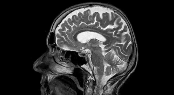 Descubren 13 errores genéticos que aumentan el riesgo de cáncer cerebral
