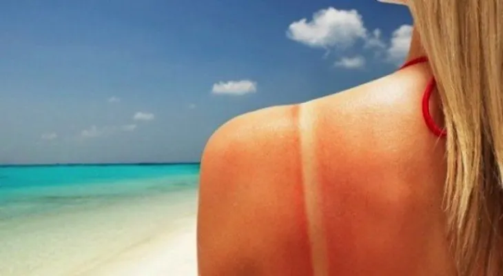¿Se te pasó la mano con el sol? Aquí tienes la solución