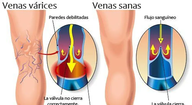 Remedios para varices: romero, hamamelis, caminar 30 mitutos y baños de agua fría y caliente