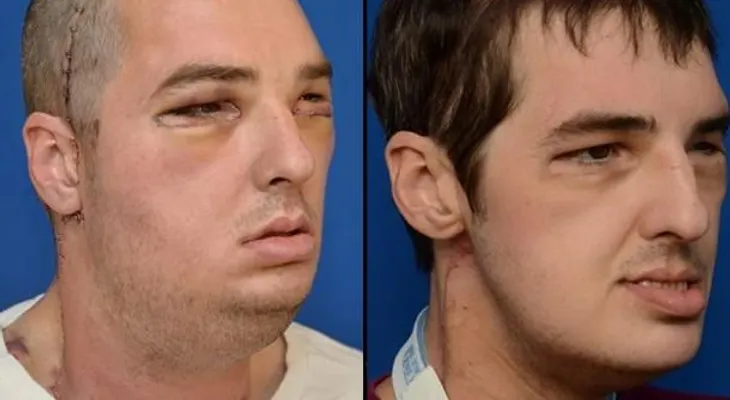 El hombre que encontró un rostro por un milagro médico, dice que se siente "normal" 