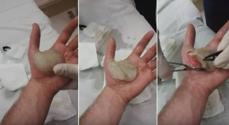Tenía una ampolla en la mano, y cuando el doctor la explotó mira lo que encontró (VIDEO)