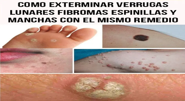 De esta manera podrás exterminar verrugas, lunares, fibromas, espinillas y manchas con el mismo remedio