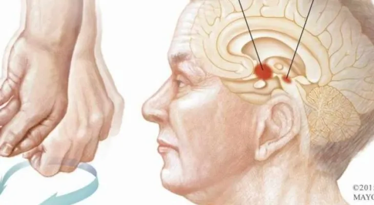 Es difícil predecir la velocidad de avance de la enfermedad de Parkinson