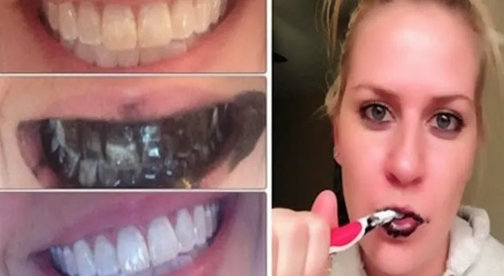 Garantizado para blanquear los dientes en siete días 