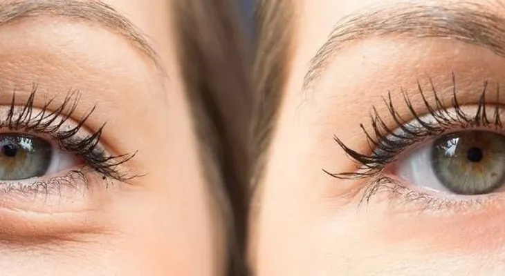 La hinchazón debajo de los ojos, cómo tratarla