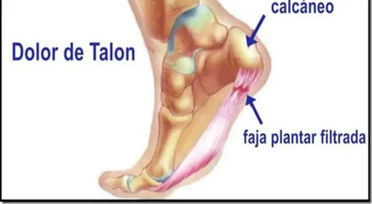 Esto es lo que le pasa a tu cuerpo si te duele el talón al despertarte o cuando estás de pie
