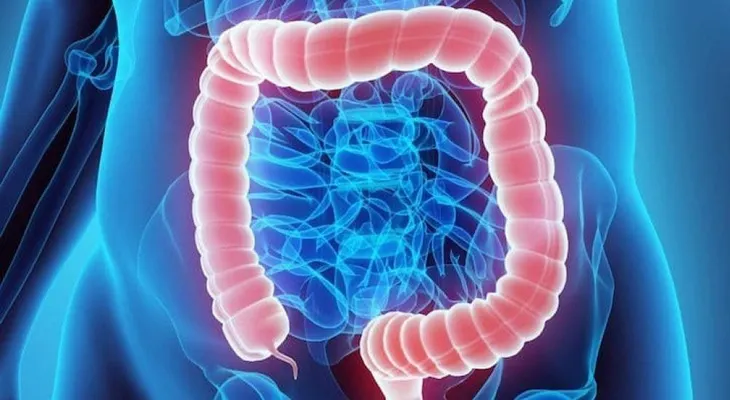 El cáncer colorrectal o de colon, el segundo más mortal en el 2020, con 935 mil muertes