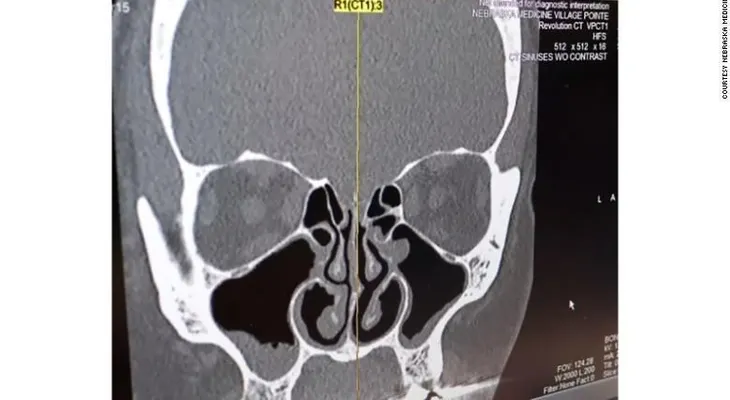 Ella pensó que tenía una fuerte gripe, pero era líquido saliendo de su cerebro