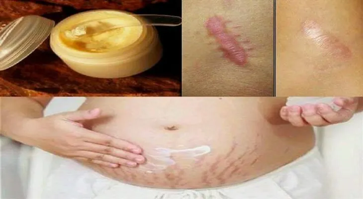 Si quieres eliminar las cicatrices en dos semanas prueba esta crema 