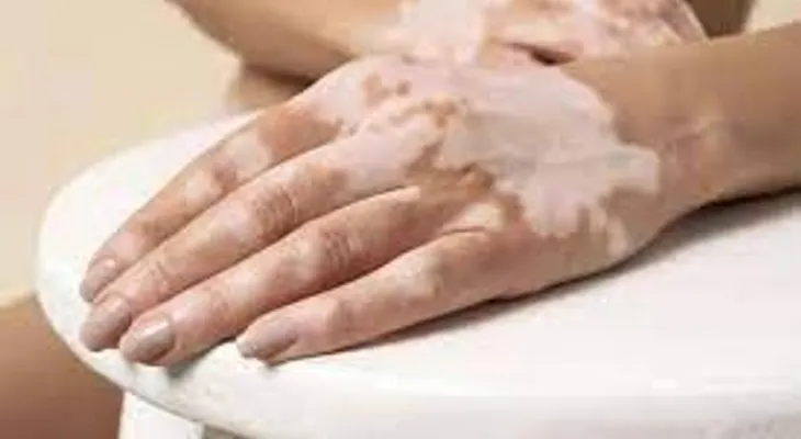 Revelan tratamiento para el vitiligo, Melagenina Plus, desarrollado en Cuba