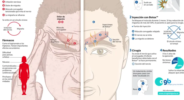 Un nuevo tratamiento para combatir la migraña con cirugía (VIDEO)