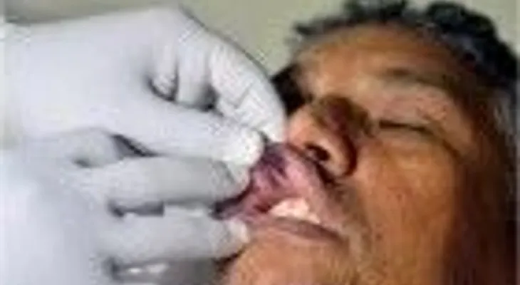 Operan del labio superior a Danny Polanco