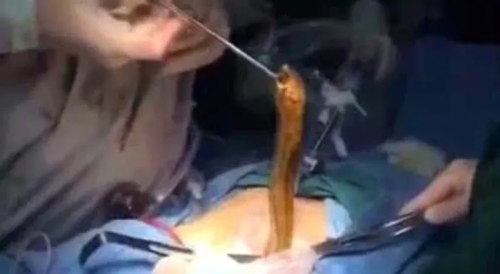 En una operación impactante un médico saca una angila del estómago de un paciente, que se la metió por el ano