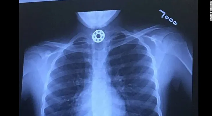 Una niña se asfixió con una pieza de un fidget spinner