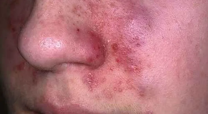 Tratamiento natural para la dermatitis seborreica