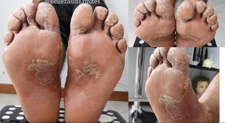Lo mejor para hongos en los pies; vinagre, jengibre y bicarbonato