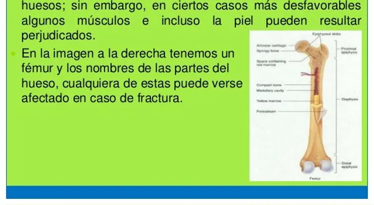 ¿Sabías que cada 3 segundos ocurre una fractura osteoporótica?