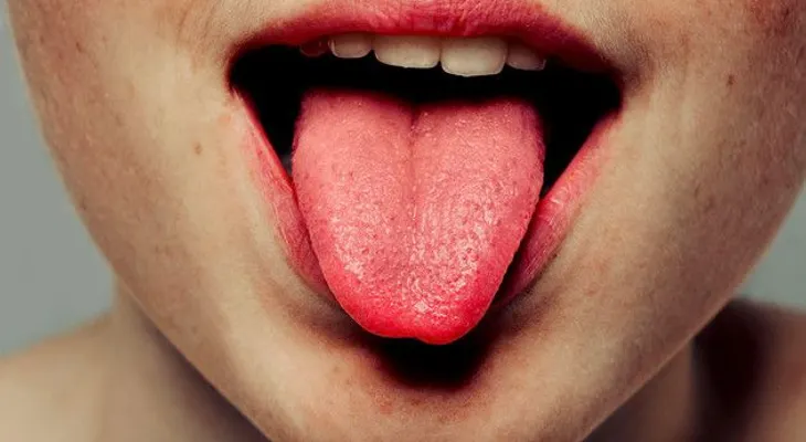 Siete problemas de salud que puedes detectar mirando tu lengua