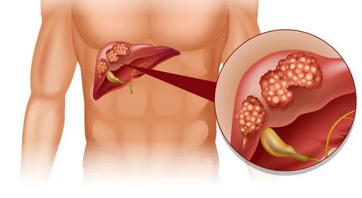 Jugo medicinal con perejil para mejorar el hígado