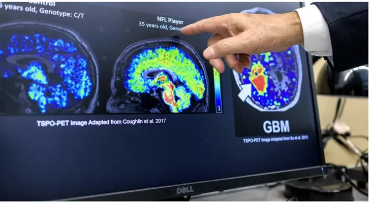 Latinos en EE.UU. hallan biomarcador contra Alzheimer
